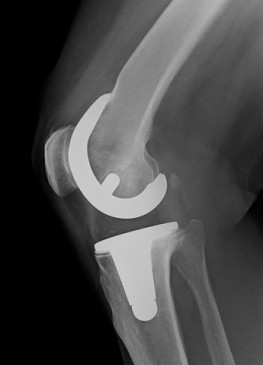 Totalendoprothese im rechten Knie